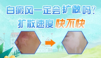 儿童皮肤有块白斑